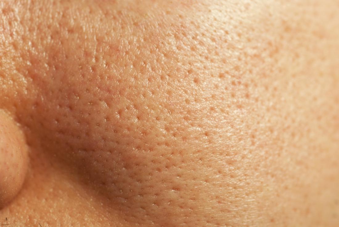 large-pores-on-the-face-and-how-to-get-rid-of-large-pores